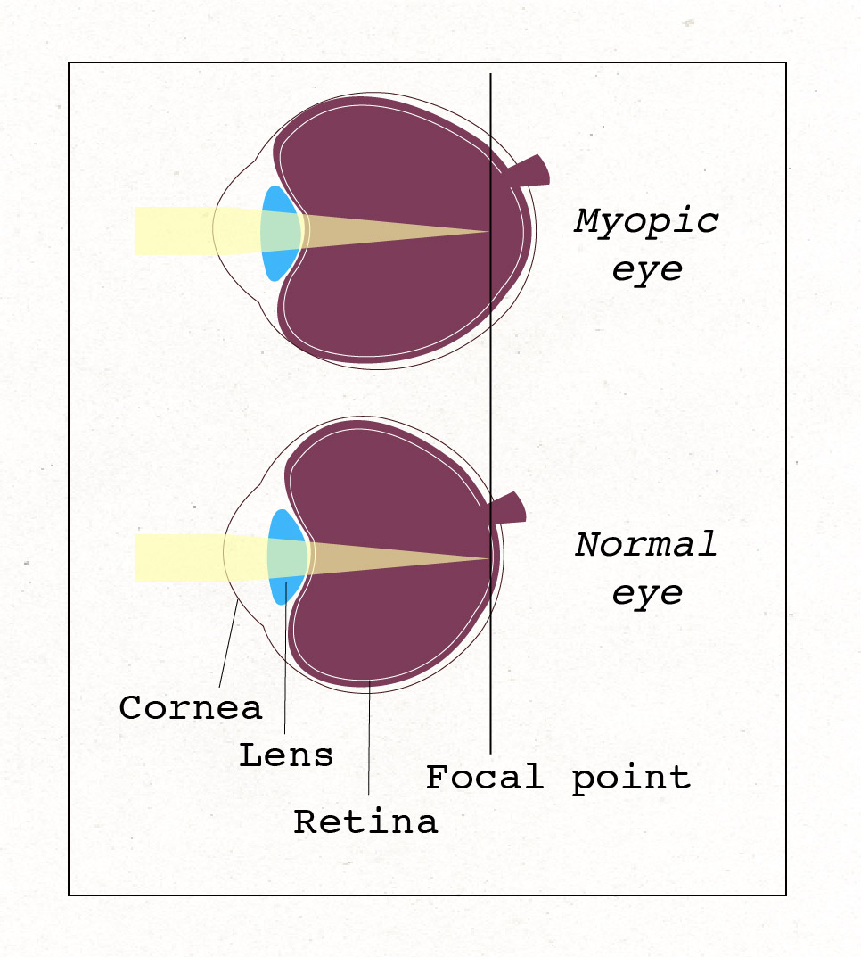 An illustration of a regular eye sits next to an illustration of a myopic eye, which is slightly longer horizontally, and causes the light to come to a focus in front of the retina instead of on the retina. Glasses diverge the light so it comes to focus on our retina and we can see in focus.